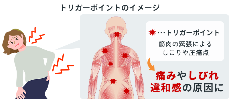 トリガーポイントイメージ